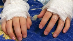Festejos navideños dejan menores con quemaduras y amputaciones por uso de pólvora