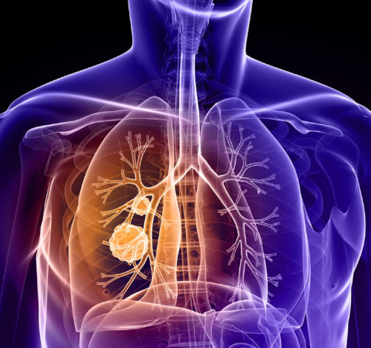 El cáncer de pulmón no microcítico ha aumentado un 16% en los últimos 5 años, según un estudio