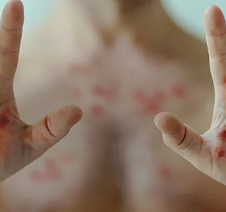 Este año se han registrado 15.000 contagios y 461 muertes por el virus