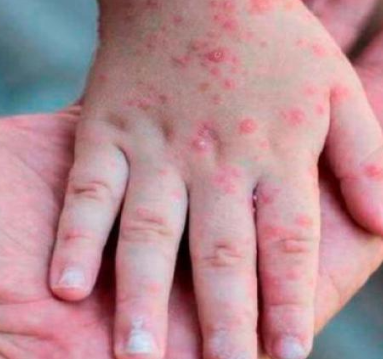 Organismos sanitarios piden más medidas de control tras el primer caso de mpox en Europa