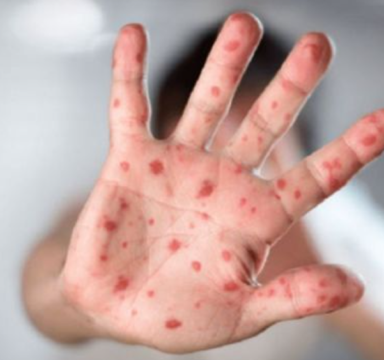 Los expertos de la salud han alertado sobre la viruela que podría llegar al país