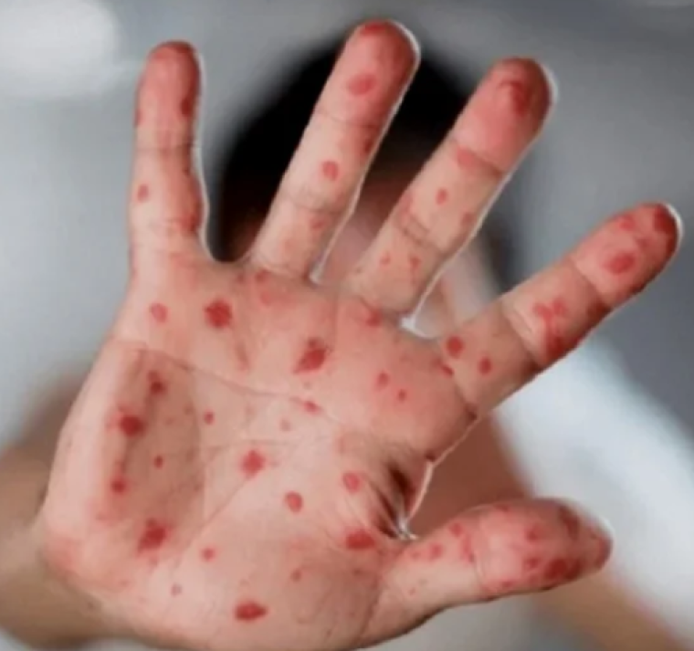 El centro de control de enfermedades de Alemania informa del primer caso de la nueva variante mpox 