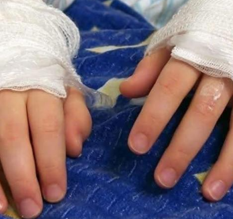 Festejos navideños dejan menores con quemaduras y amputaciones por uso de pólvora