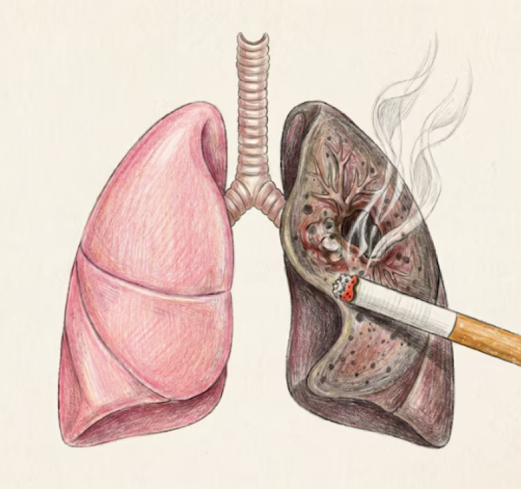 ¿Por qué aparece el cáncer de pulmón en personas que nunca han fumado? 